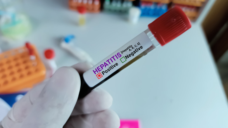Hand wearing glove holding positive sample of hepatitis
