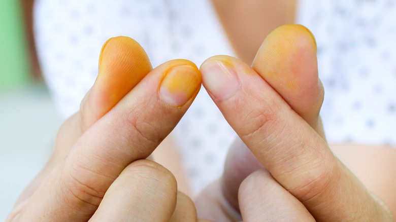 Turmeric stain on fingers